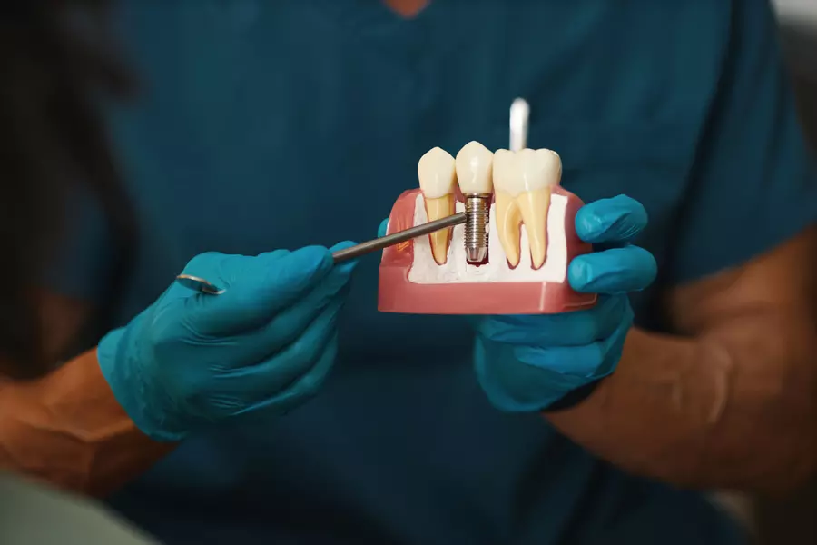 illustrating-dental-implant-procedure-on-model-2026-01-07-07-10-50-utc.webp